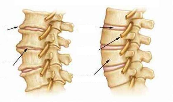 Zer da osteochondrosia
