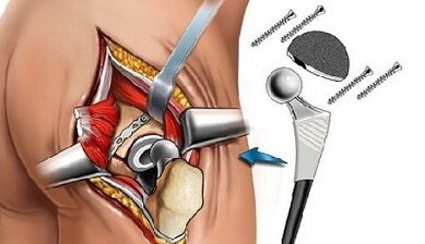 Hip Artrosiaren Endopretikoak
