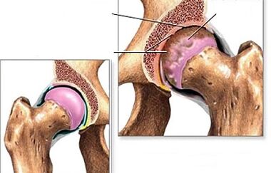 Hip artrosiaren diagnostikoa