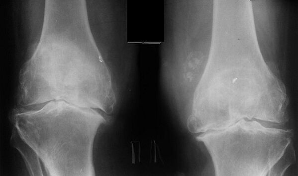 X -Ray belauneko artikulazioaren artrosia diagnostikatzeko modu gisa
