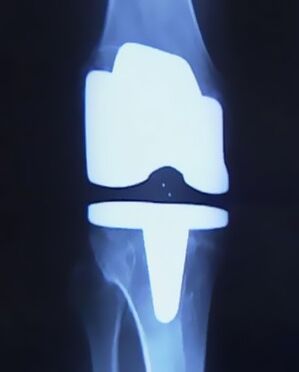 Protesi artifizial batekin belauneko erradiografia artikulazioen ordezko kirurgia egin ondoren